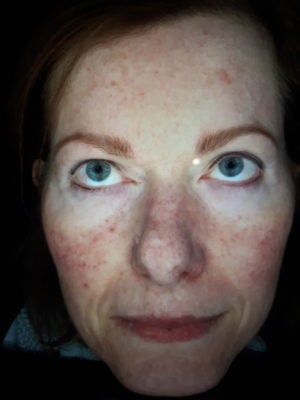My Rosacea Story - Week 1 - Wilma