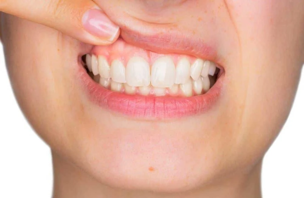 CHECKING THE GUM LINES - Successful Self-Dentistry in 8 Steps - Organic and Natural Dental Care