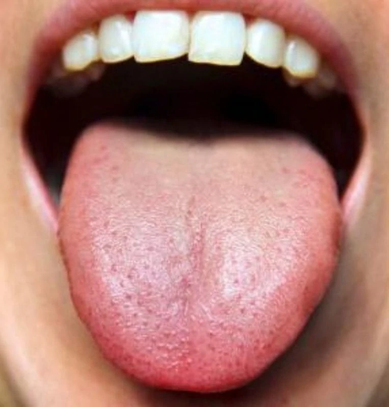 Ayurveda | What is Your Tongue Telling You?