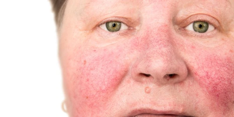 rosacea dutch health store